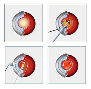 cataract-image-small