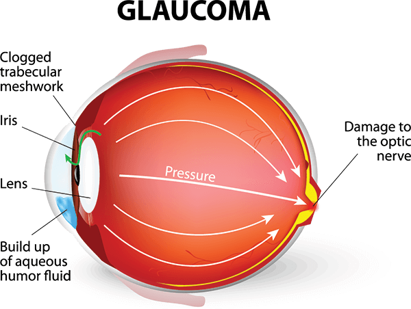 glaucoma-chart