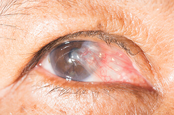 Pterygium